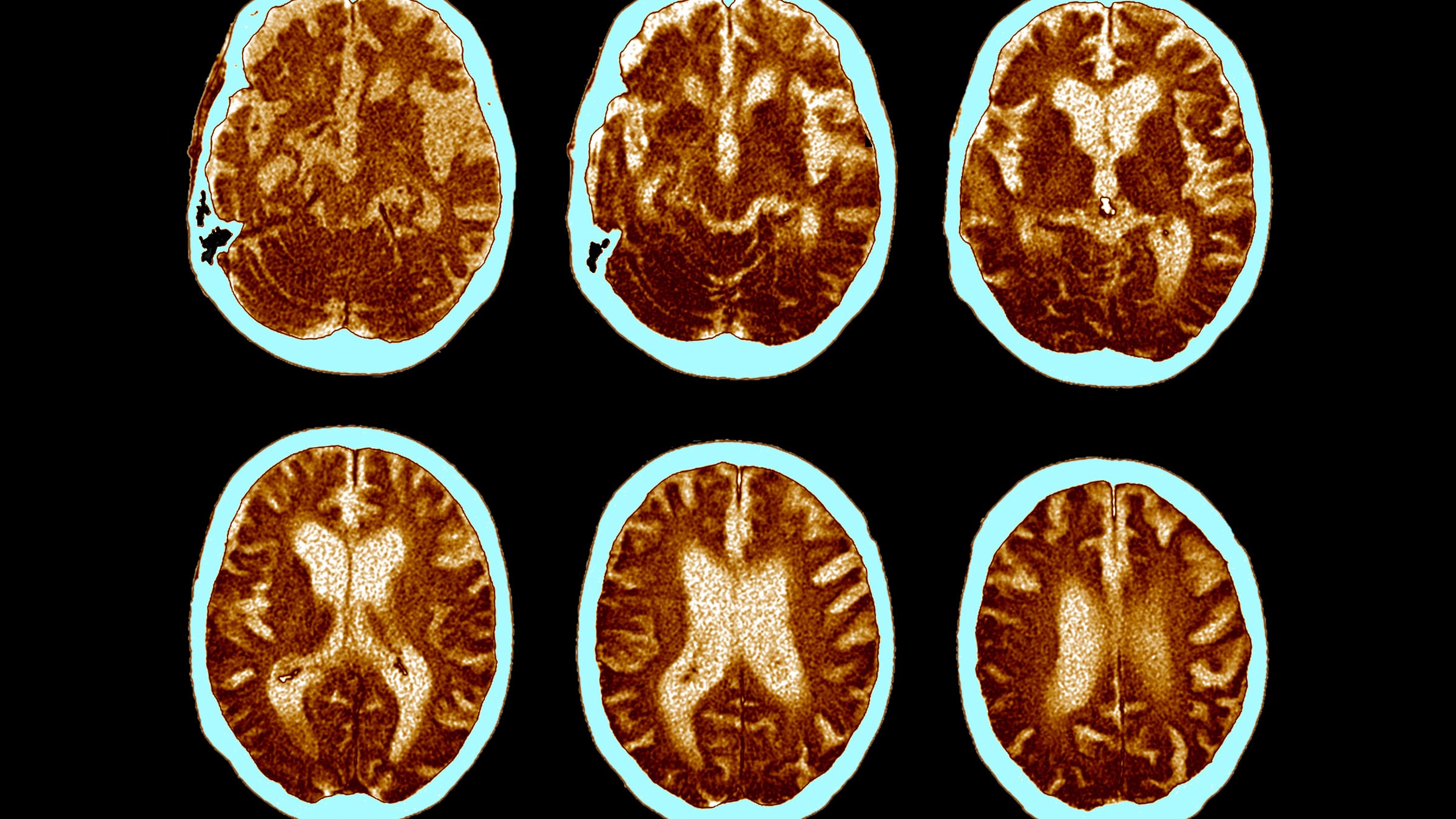 cat scans of brains that have developed Alzheimer's