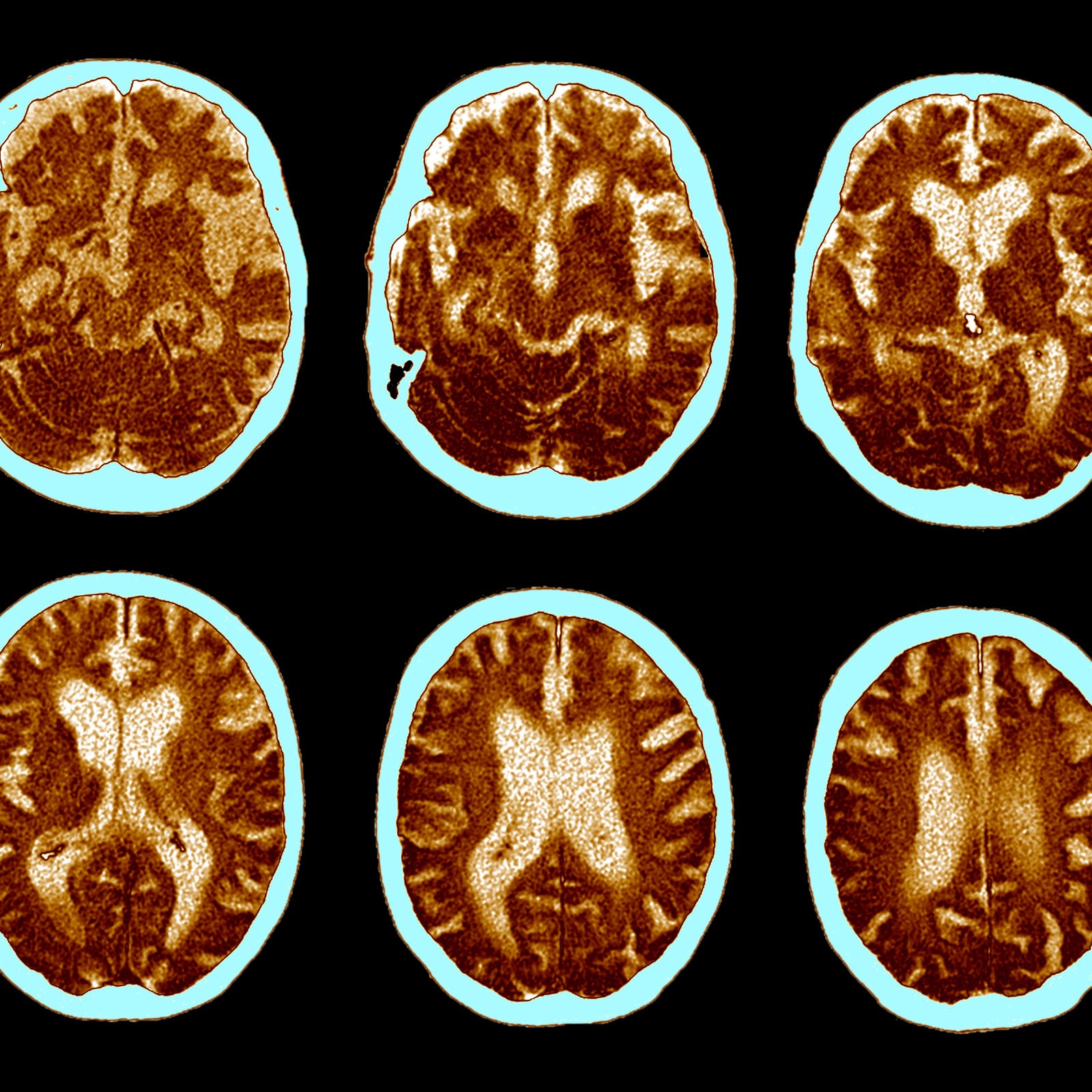 cat scans of brains that have developed Alzheimer's 