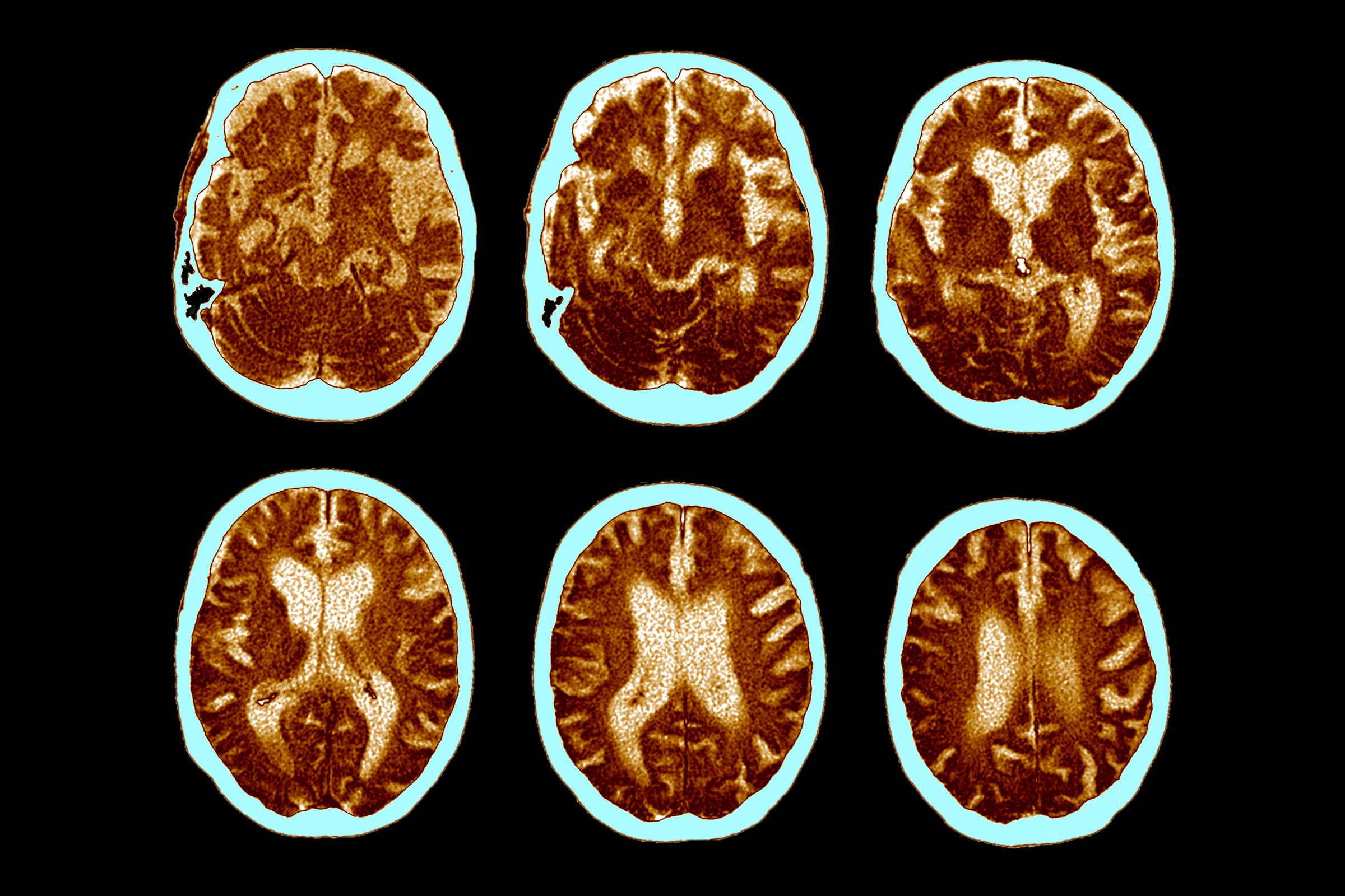 cat scans of brains that have developed Alzheimer's